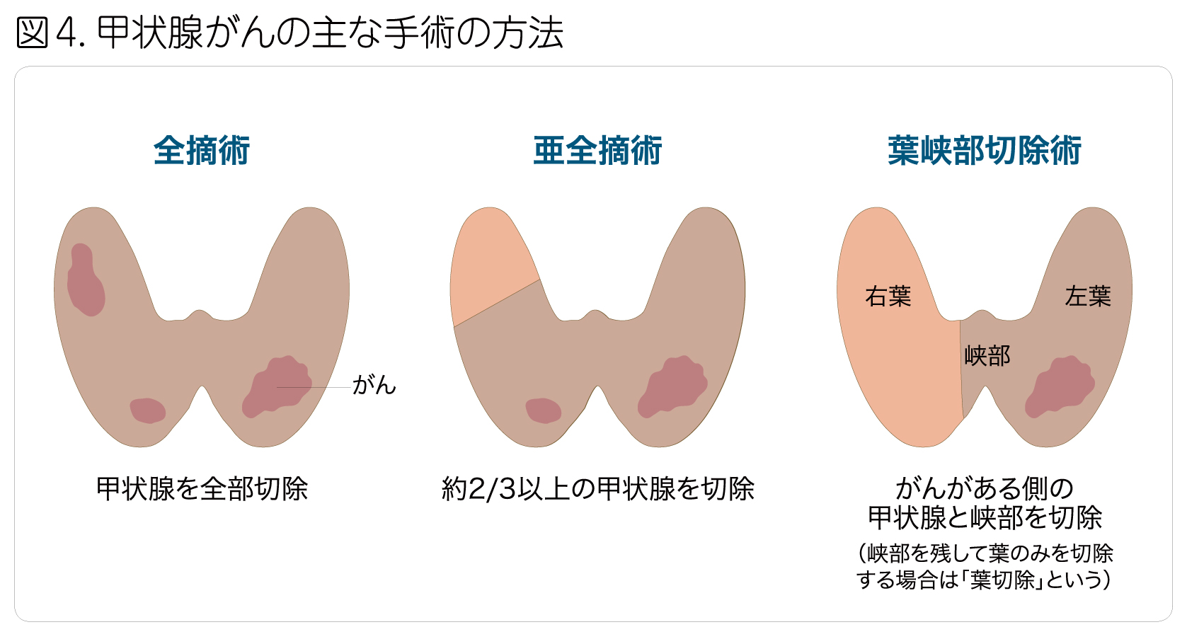 甲状腺葉切除術には何が含まれますか?